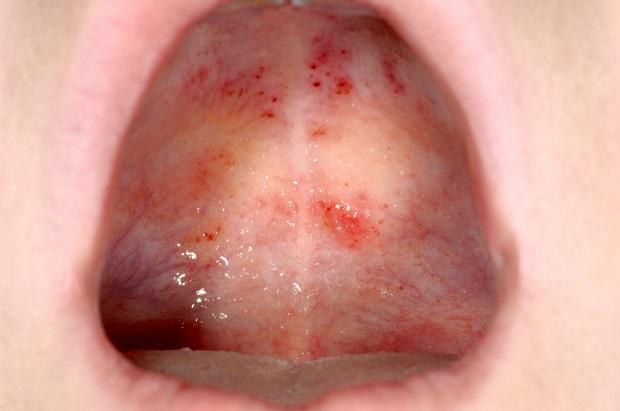 Roof of mouth showing small red dots, called petechiae.