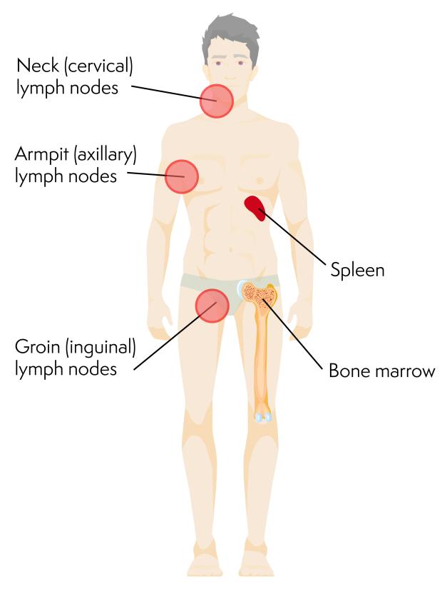 Illustrated person with neck lymph nodes, armpit lymph nodes, groin lymph nodes, spleen and the bone marrow highlighted to show where CLL is often found in the body.