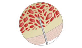 Illustration of a bone marrow biopsy 