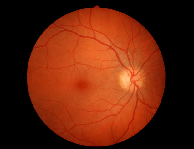 Blood vessels in a healthy eye that look thin and well defined 