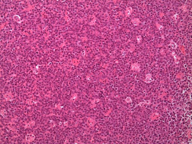 Cells from a biopsy of DLBCL