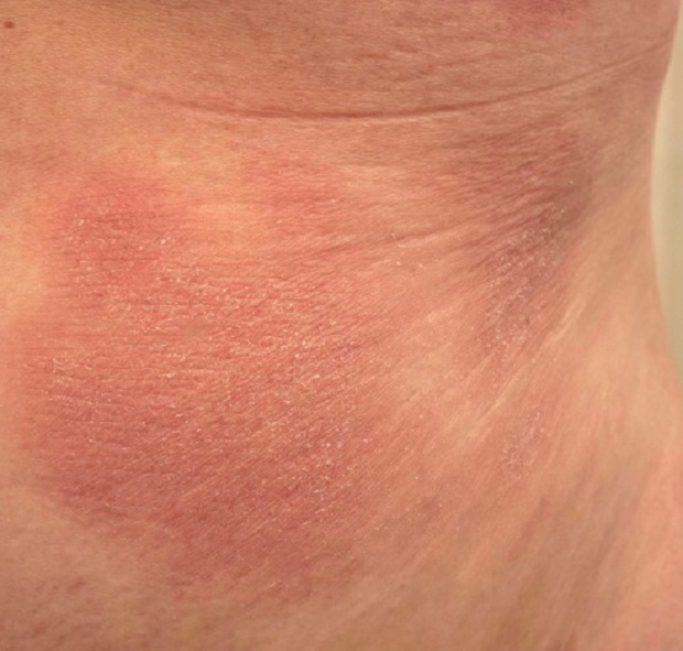 Patches of mycosis fungoides showing areas of dry, red skin