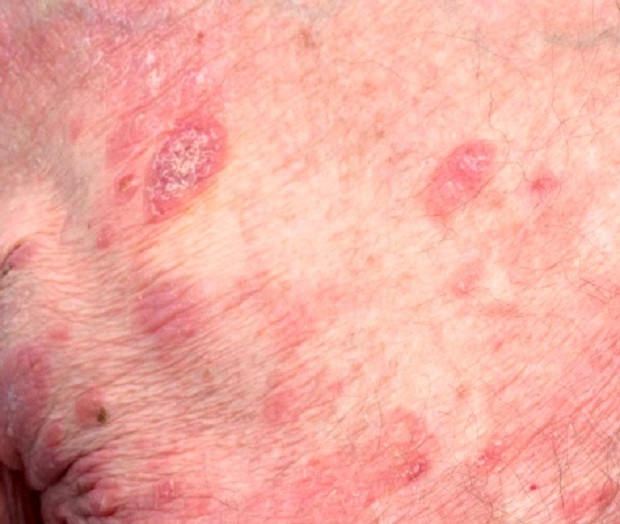 Plaques of mycosis fungoides     