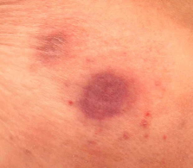 Lymphoma Lesions On Skin