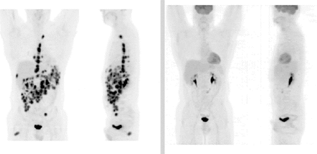 Image of a PET scan showing response to treatment