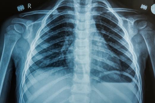 An  x-ray scan of a chest