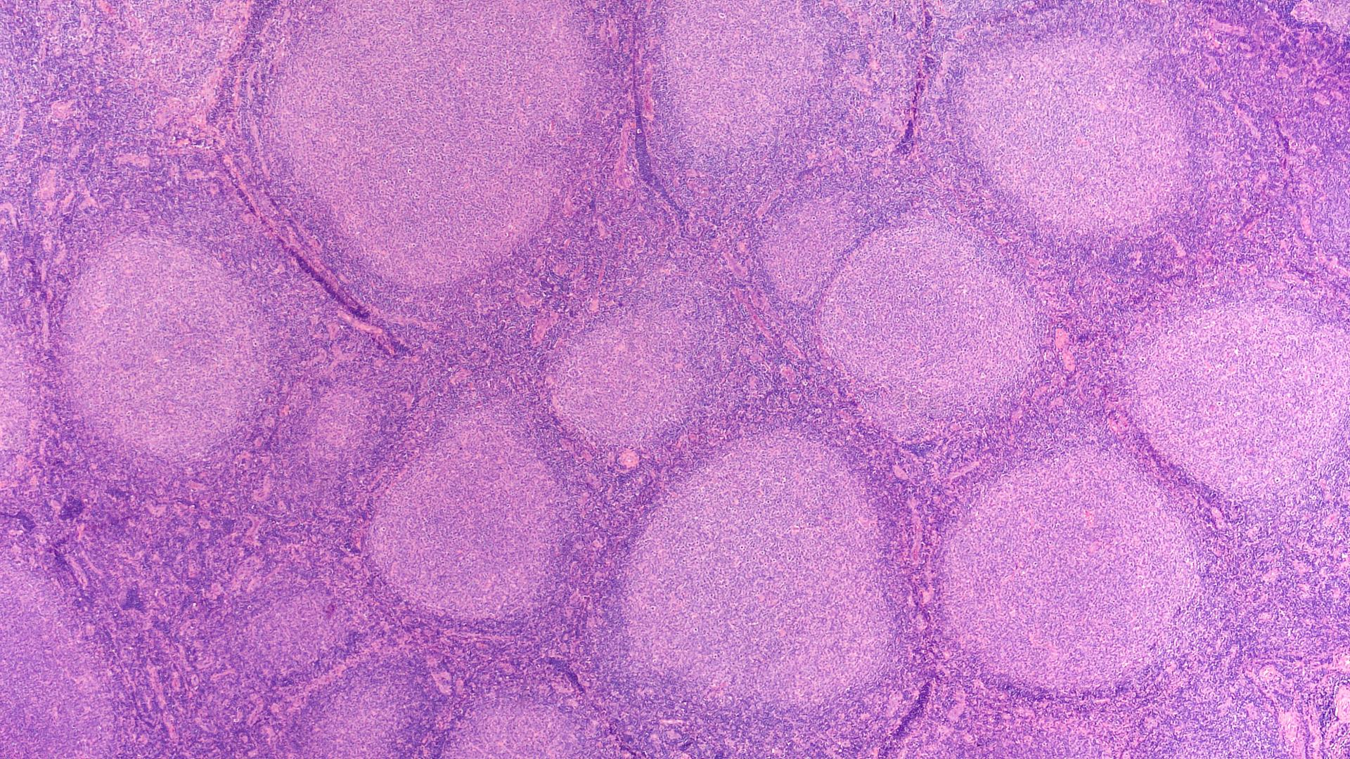 Microscope slide showing follicular lymphoma cells