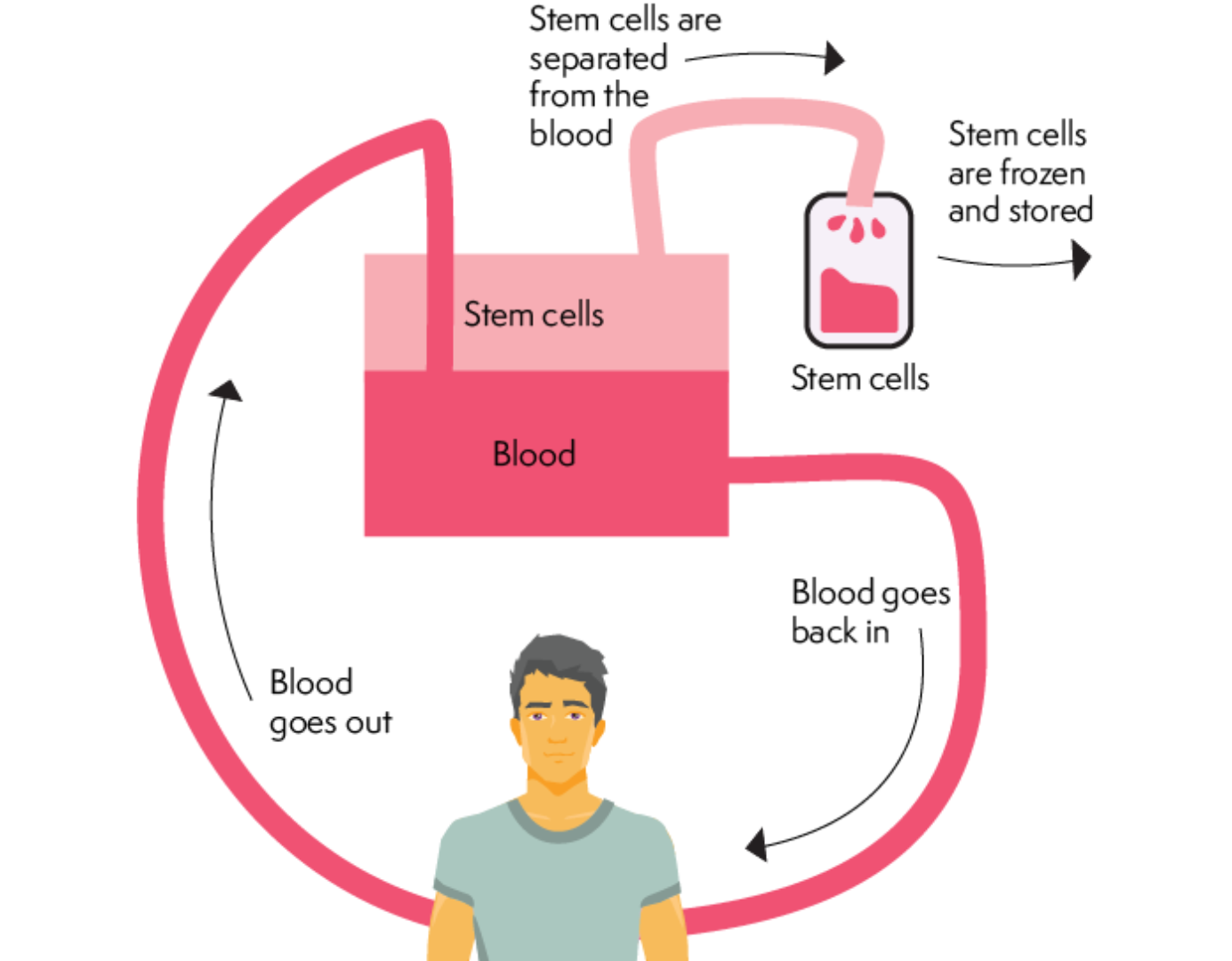 Illustrated cycle of a stem cell transplant. Shows blood going out of the body. Stem cells are separated from the  blood, frozen and stored. Blood goes back into the body.