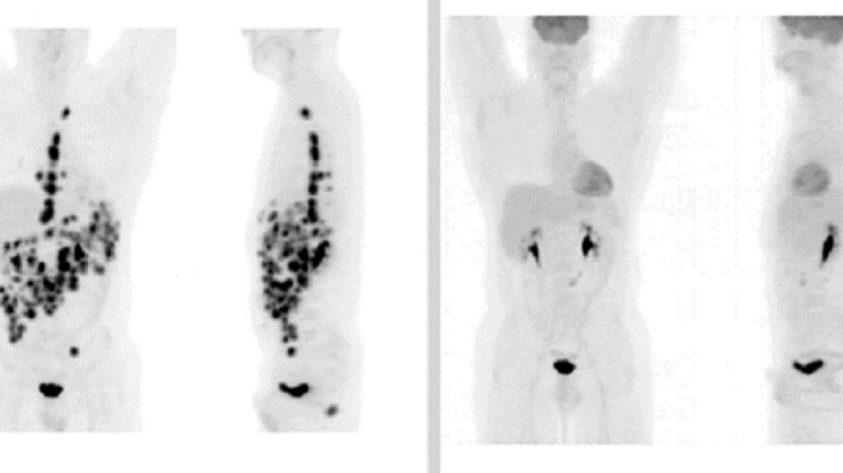 Lymphoma Action | PET/CT Scan