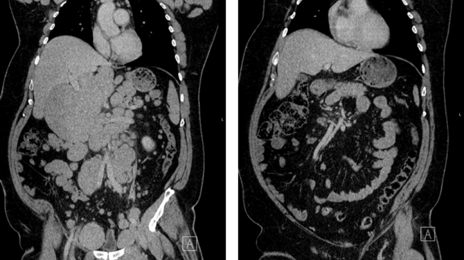 Image of a CT scan showing response to treatment