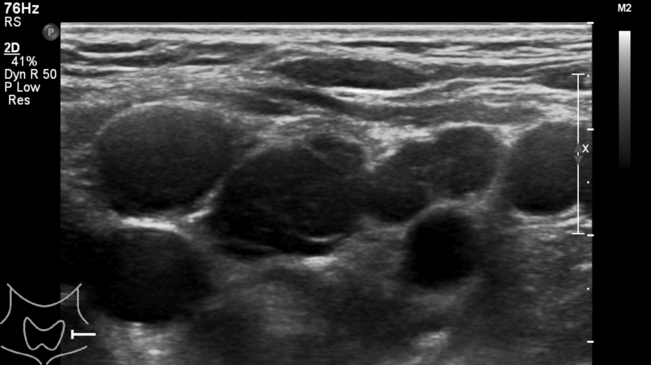 Ultrasound scan image of lymph gland (lymph nodes) in the neck.