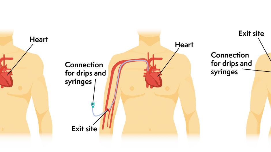 Three illustrations showing the different types of central line. These are a portacath, a peripherally inserted central catheter and a tunnelled central line