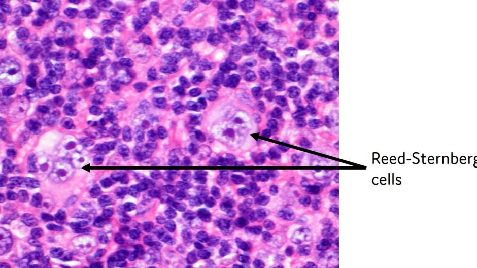 Pink and purple cells under a microscope. Black arrows pointing to a group of cells that look like owl-eyes with a label 'Reed-Sternberg cells''