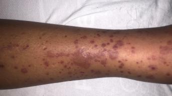 Red and purple patches on a the skin of a leg, known as purpura