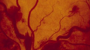 Close-up picture of blood vessels in an eye with hyperviscosity. The veins are wider and there is some swelling. 