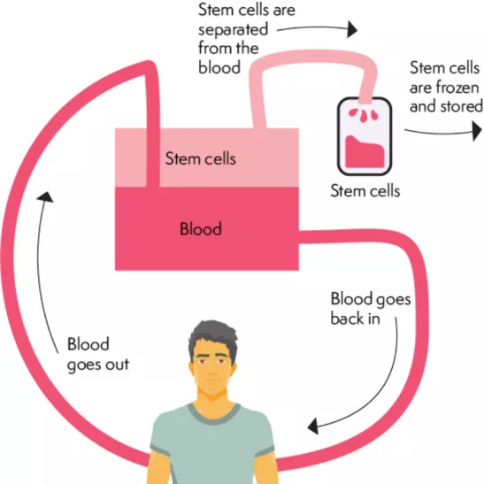 Illustrated cycle of a stem cell transplant. Shows blood going out of the body. Stem cells are separated from the  blood, frozen and stored. Blood goes back into the body.