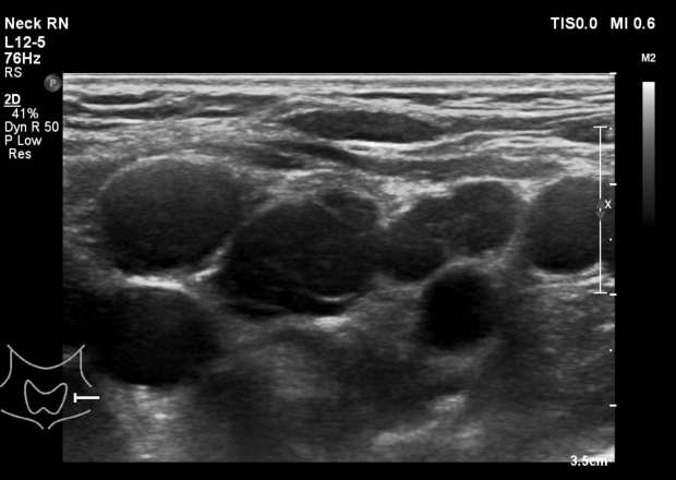 Ultrasound scan image of lymph gland (lymph nodes) in the neck.