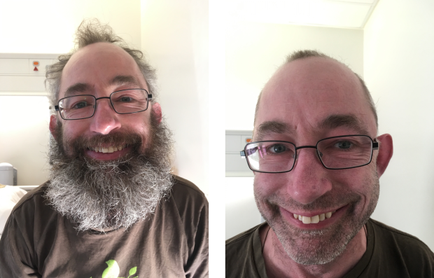 A before and after photo of a middle aged man with a beard and hair compared to the same man with no beard and very little hair