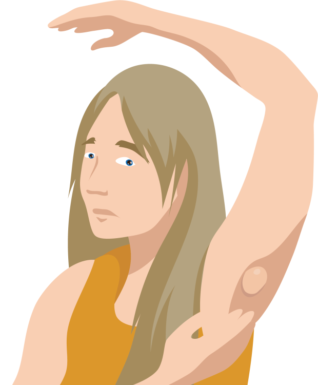 Illustration of a young white woman showing a swollen node under her armpit