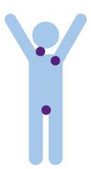 Light blue figure person with purple dots in the neck, armpit and groin