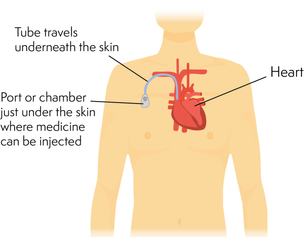 Child illustration showing how a portacath works