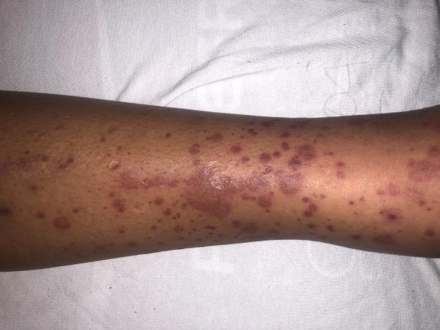 Red and purple patches on a the skin of a leg, known as purpura