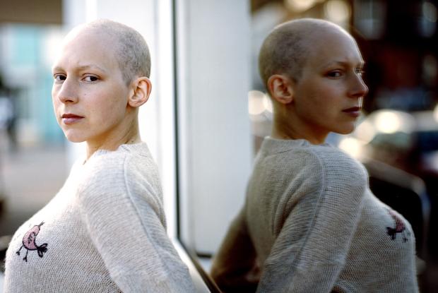 Young lady without hair