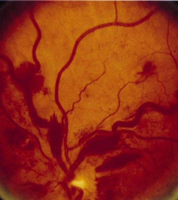 Close-up picture of blood vessels in an eye with hyperviscosity. The veins are wider and there is some swelling. 