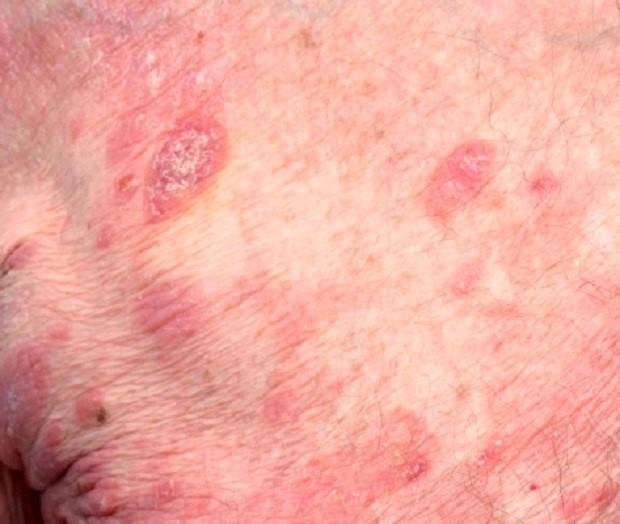 Thick small red patches on the skin (plaques)