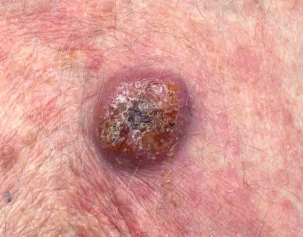 Large and raised swelling (tumour)