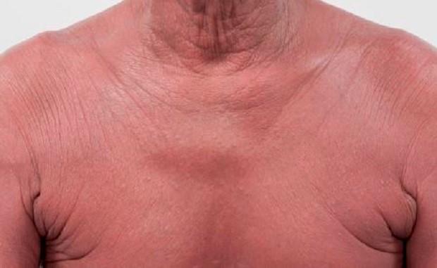 Reddened skin on the chest