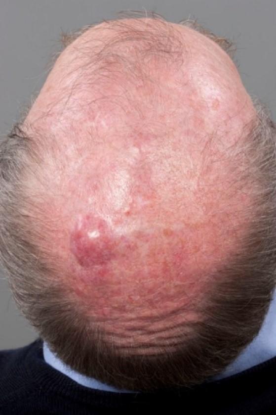 Deep red lump (tumour) on a man's head
