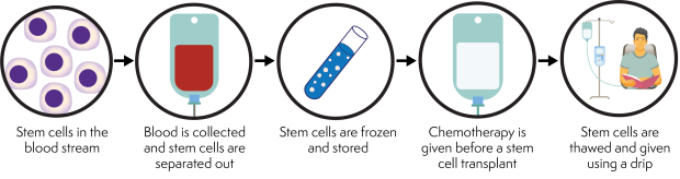 Illustrated circles showing the stem cell transplant process. Step 1: blood cells in the blood stream get collected and stem cells are separated out. Step 2: stem cells are frozen and stored. Step 3: chemotherapy is given. Step 4: stem cells are thawed and given.