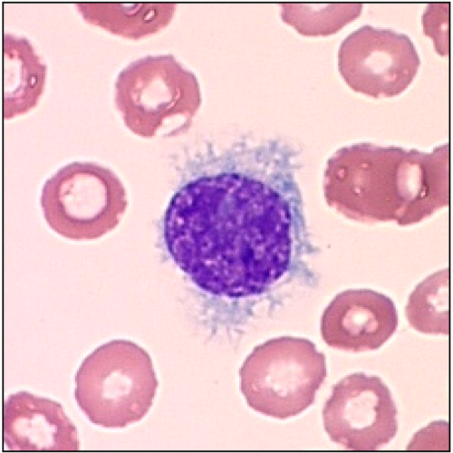 Purple cell with ruffles coming off it, surrounded by other red blood cells