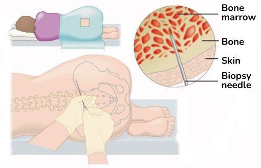 Someone laying on there side having a bone marrow biopsy procedure, includes a close up image of the structure bone marrow