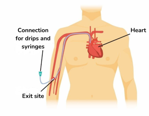 Person with PICC line fitted.