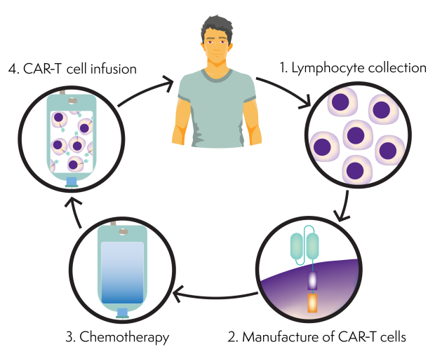 Stages of CAR-T cell therapy. Image of a man with an arrow to 1. Lymphocyte collect, with an image of lymphocyes. Arrow to 2. Manufacture of CAR-T cells with image of CAR-T cell. Arrow to 3. Chemotherapy, with image of a chemotherapy drug infusion bag. Arrow to 4. CAR-T cell infusion, with image of infusion bag containing CAR-T cells. Arrow back to man.